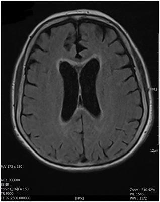 Paraneoplastic Neuromyelitis Optica Spectrum Disorder Associated With Lung Adenocarcinoma: A Case Report